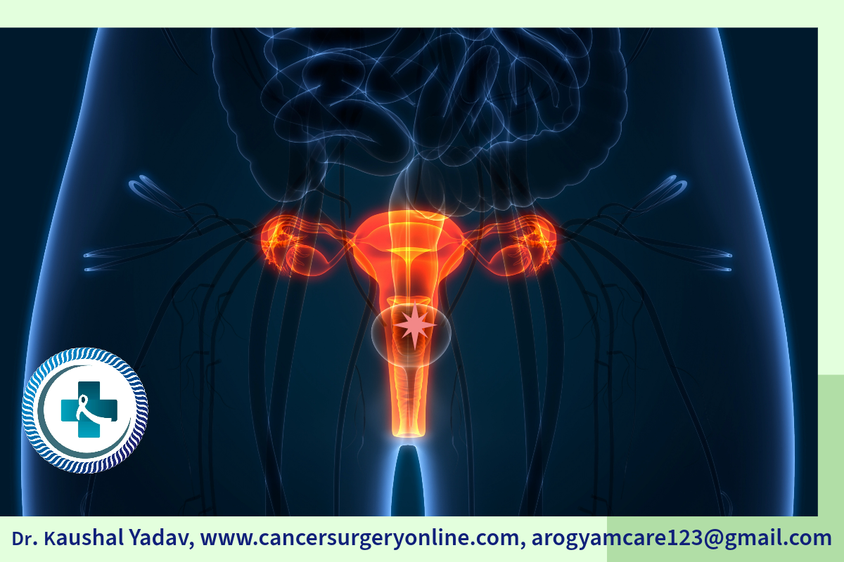 Cervix Cancer Illustration