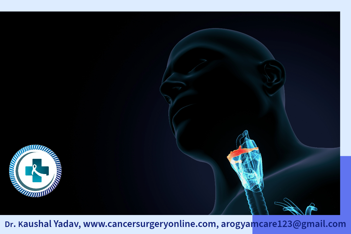 Larynx Cancer illustration