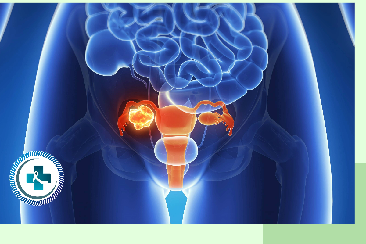 Ovarian Cancer illustration by cancersurgery.online, surgonco.com