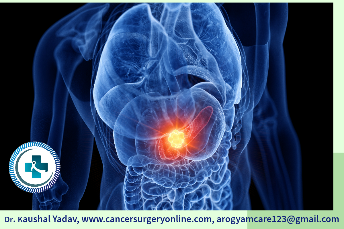 Pancreas Cancer Illustration