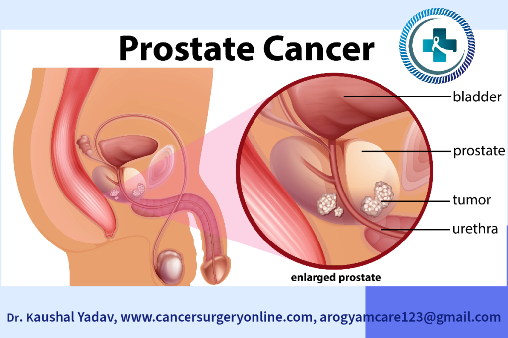Prostate Gland with Cancer