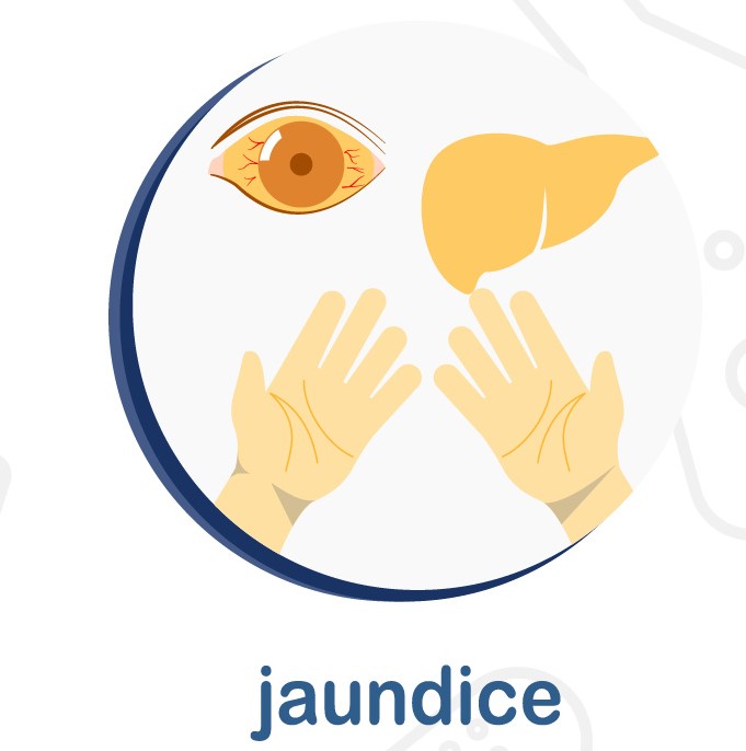 Jaundice can be a symptom of pancreatic cancer