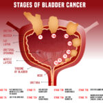 bladder cancer images