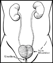 Neobladder with radical cystectomy