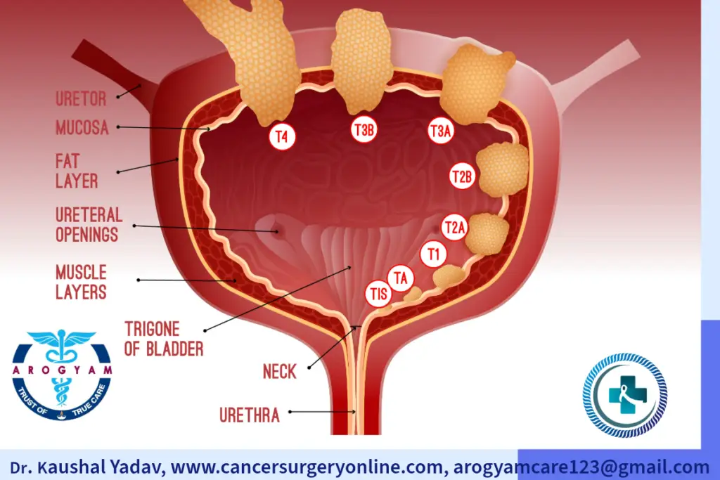 Urinary Bladder Cancer stages
