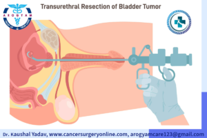 Transurethral resection of Bladder Tumor