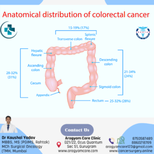 Location of colorectal cancer in large intestine in abdomen
