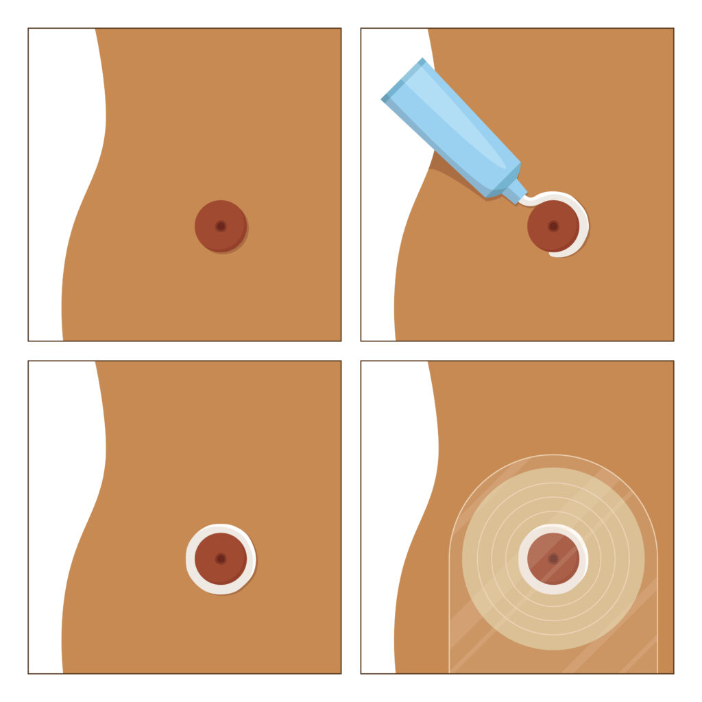 How to apply stoma bag. How apply colostomy bag