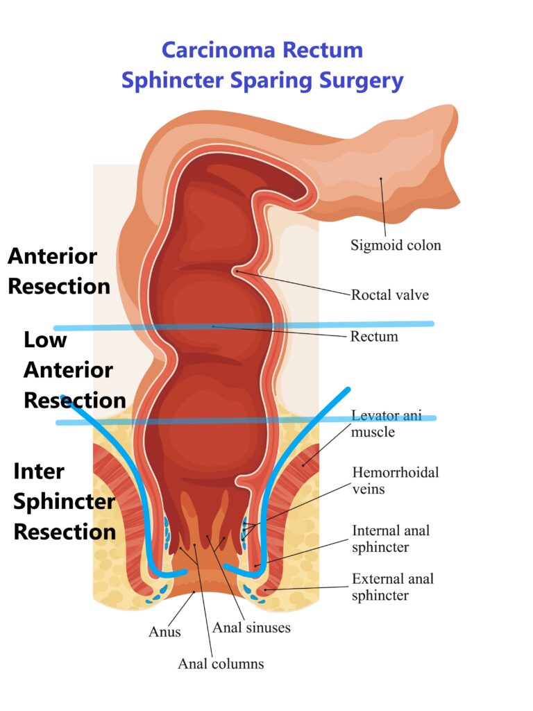 Sphincter sparing surgery, low anterior resection, LAR, Intersphincter Surgery