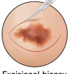 Excision Biopsy