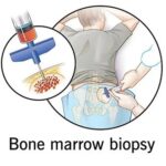Bone Marrow Biopsy