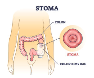 Stoma bag after Colostomy stoma for rectum cancer surgery