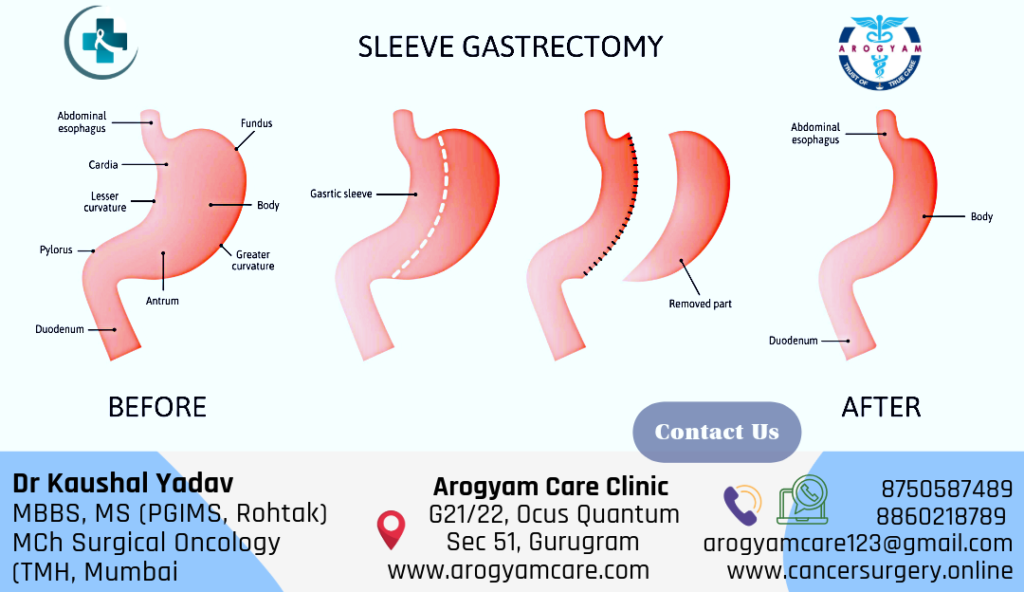 Sleeve Gastrectomy for GIST tumor of Stomach