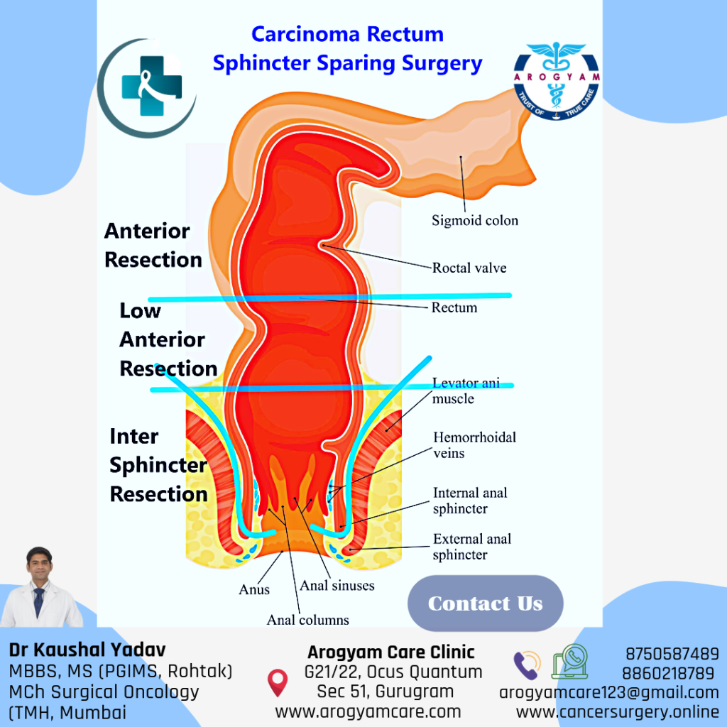 Sphincter presrving surgery in rectum cancer to avoid permanent stoma