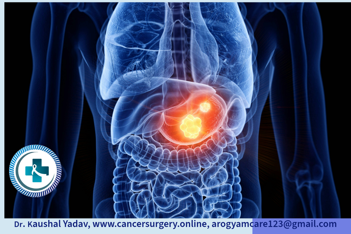 Stomach Cancer