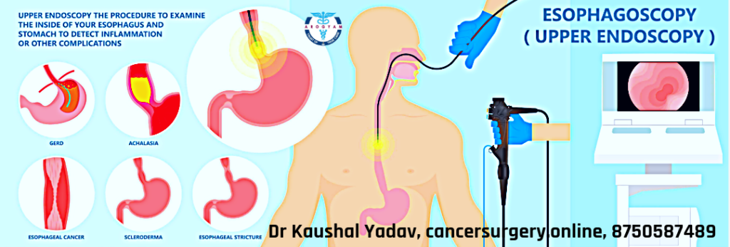 causes of dysphagia achalasia cardia, esophageal cancer diagnosis by upper GI endoscopy