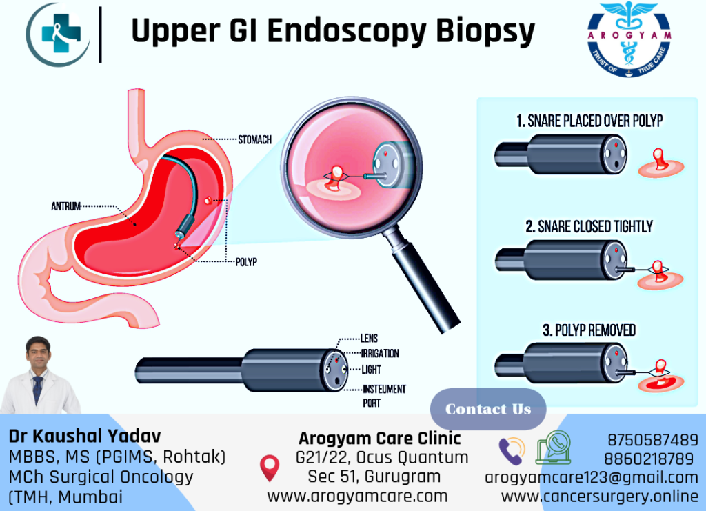 Upper GI Endoscopy Biopsy for Stomach cancer, Endoscopic Mucosal resection