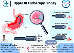 Upper GI Endoscopy Biopsy for Stomach cancer