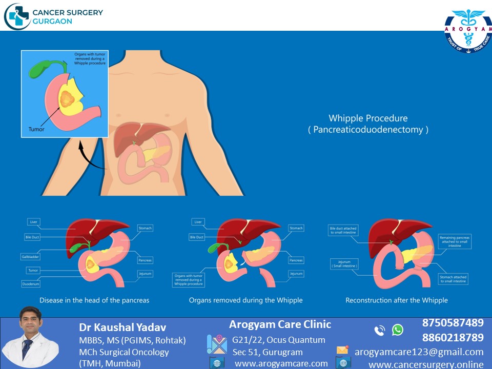 Whipple's Surgery