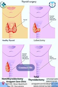 Thyroid Cancer Surgery