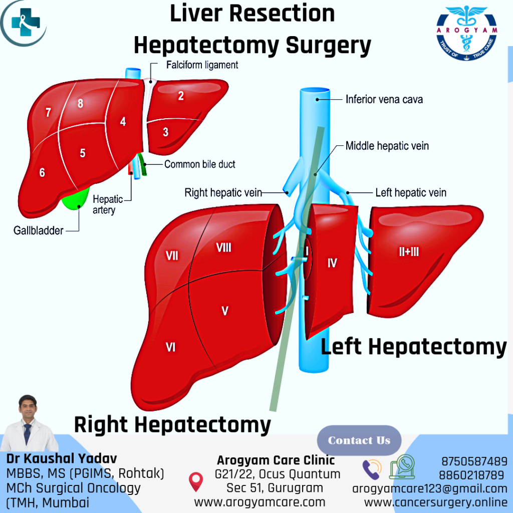 Liver Resection Hepatectomy