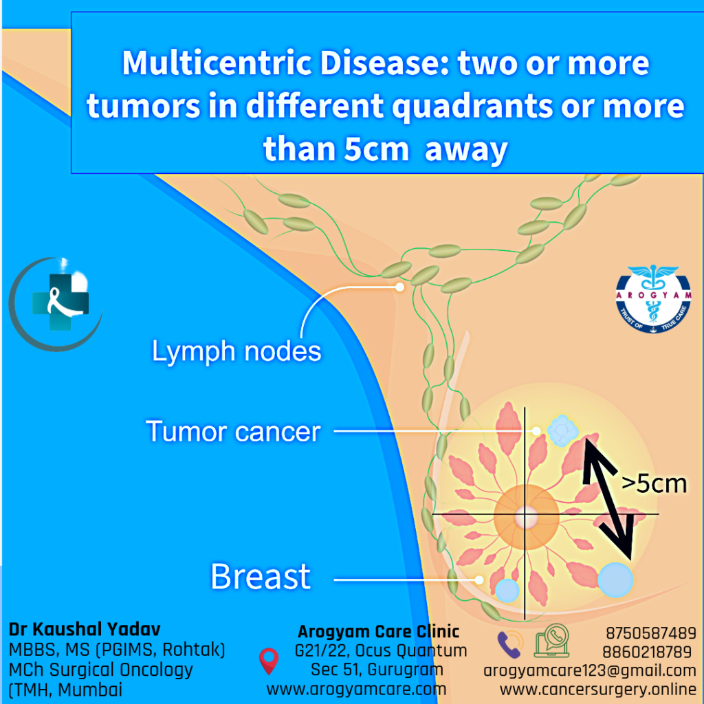 Multicentric Breast cancer