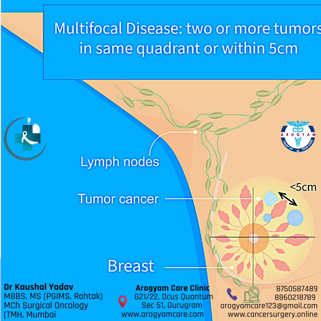 Multifocal Breast cancer