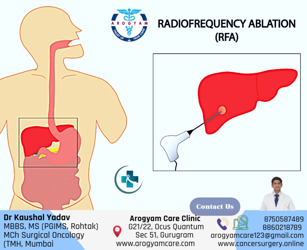 Radiofrequency Ablation