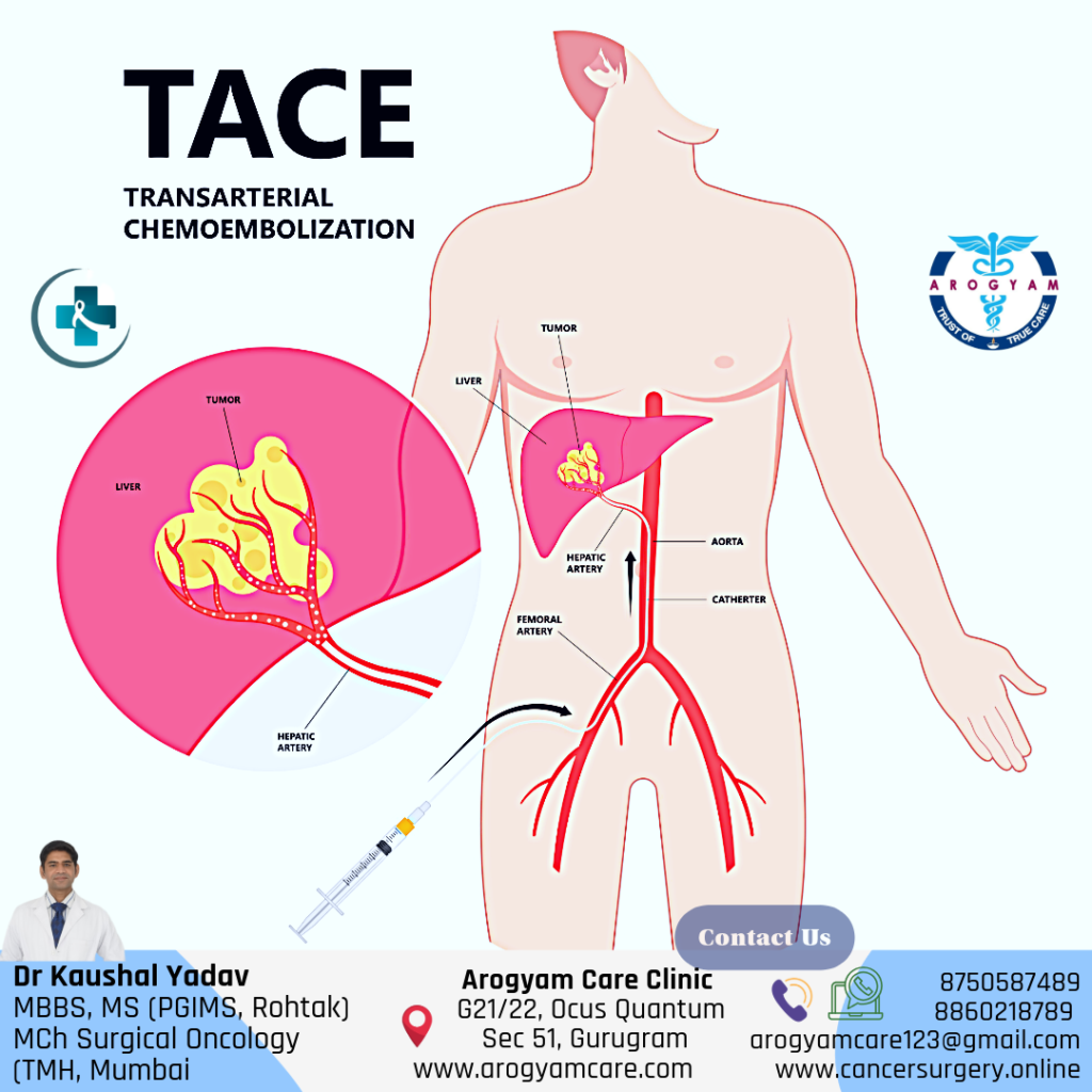 Tranarterial Chemoembolization: TACE for liver cancer