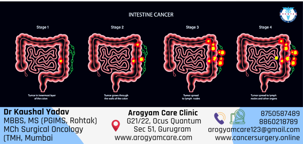 Stages of cancer