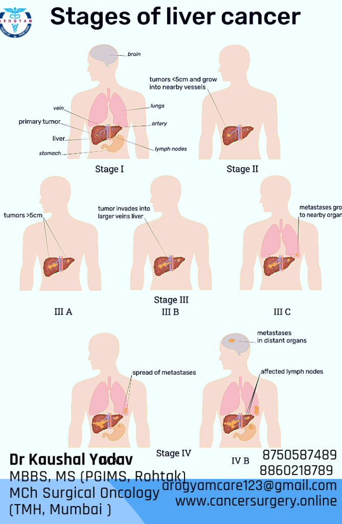 Stages of Liver Cancer